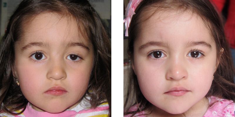 Mí mắt bẩm sinh bị sụp được chữa trị thành công, phục hồi nếp mí hoàn toàn