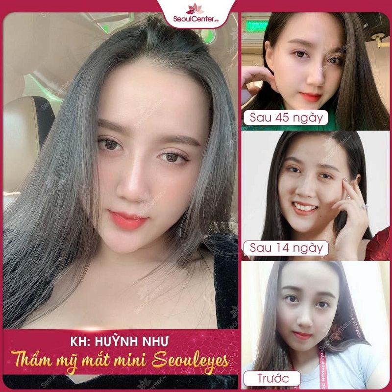 Đôi mắt sắc nét hơn sau khi cắt mí tại Seoul Center