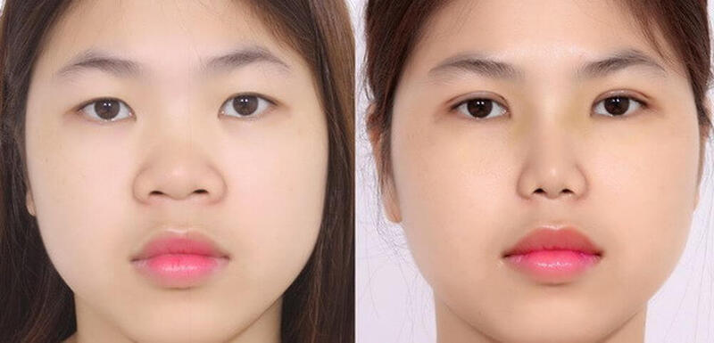 Khách hàng hài lòng và tin cậy sau khi nhấn mí tại địa chỉ uy tín Seoul Center 