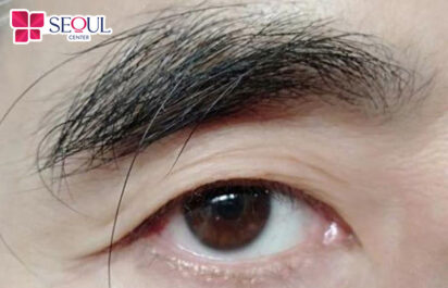 lông tài mọc ở cổ