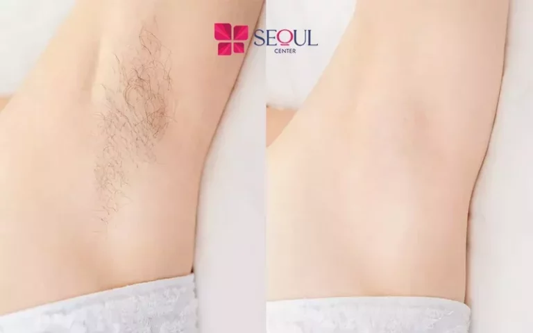 Lấy lại làn da mịn màng sau khi triệt lông bằng công nghệ Diode Laser tại Seoul Center