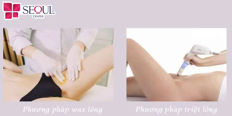 Lựa chọn triệt lông sẽ đảm bảo hiệu quả và an toàn nhất nhưng chi phí thường cao hơn so với wax lông