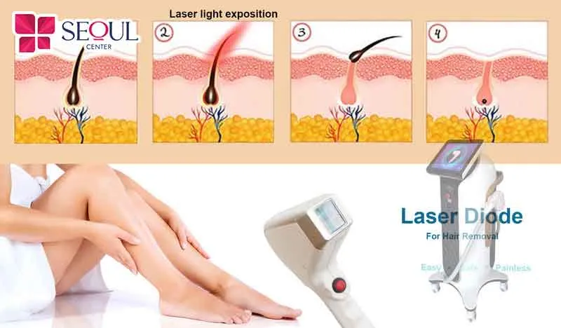 Công nghệ triệt lông Diode Laser với tia laser đơn sắc phù hợp với hầu hết loại da, kể cả làn da nhạy cảm