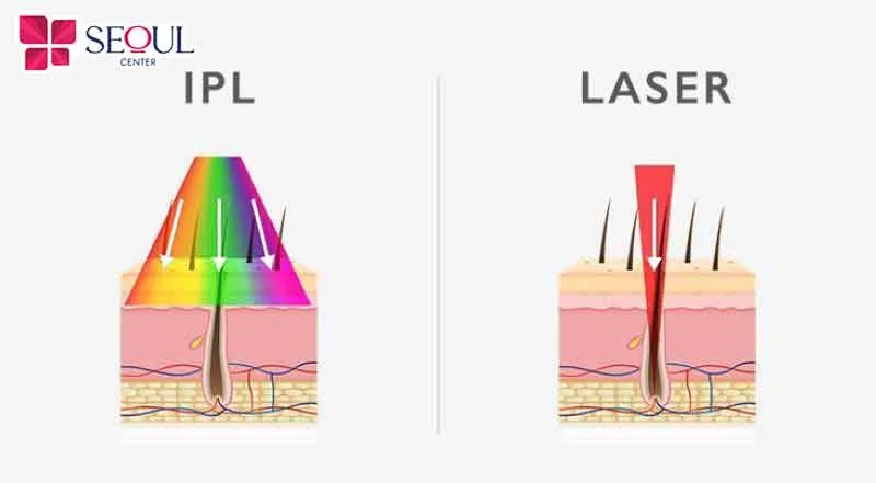 So sánh công nghệ triệt lông Diode Laser và IPL