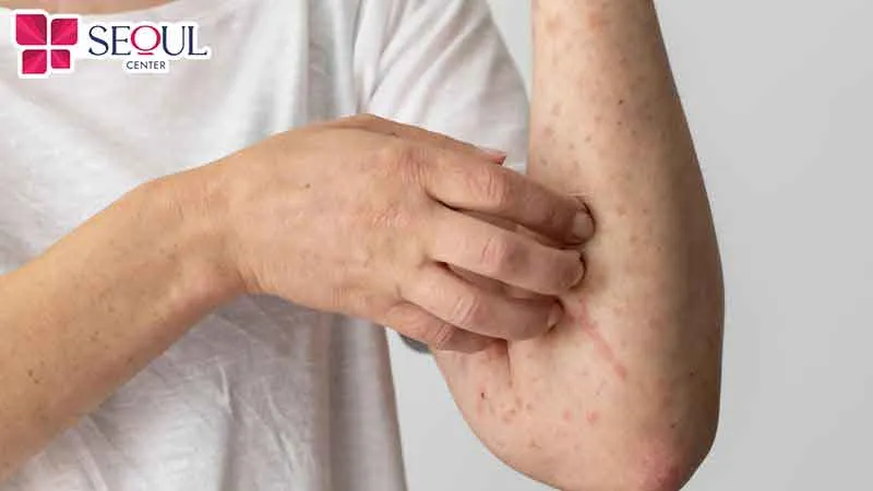 Sau triệt lông xong bị ngứa cũng có thể là hiện tượng bình thường sau triệt, có thể diễn ra chỉ trong 2-3 ngày