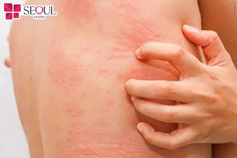 Nguyên nhân triệt lông xong bị ngứa dai dẳng có thể xuất phát từ nguyên nhân triệt lông sai kỹ thuật, không đảm bảo tiêu chuẩn an toàn