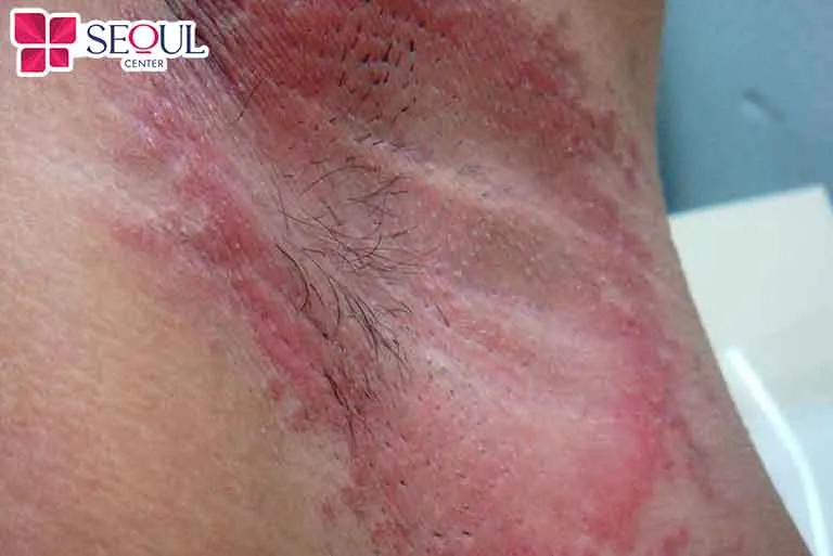 Nách vết thương, viêm nhiễm, bị chàm hoặc đang bị kích ứng thì không nên triệt lông nách bằng chanh