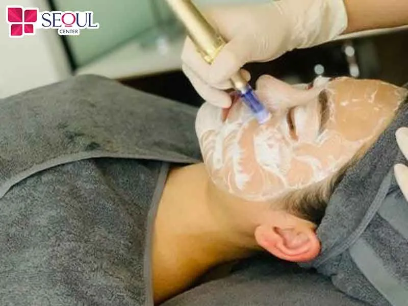 Cấy trắng da mặt là phương pháp sử dụng thiết bị có đầu kim siêu nhỏ đưa dưỡng chất làm trắng da vào trong