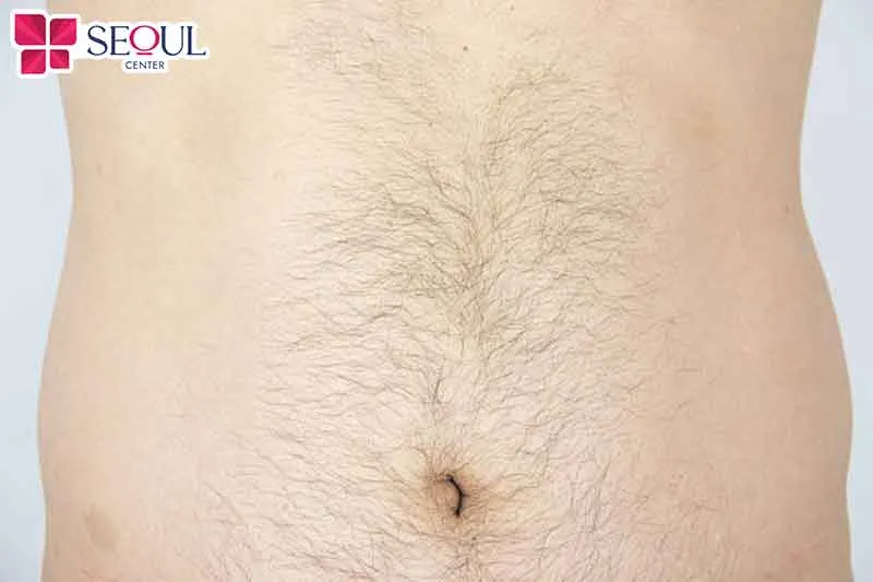 Nồng độ androgen cao khiến lông bụng mọc nhiều