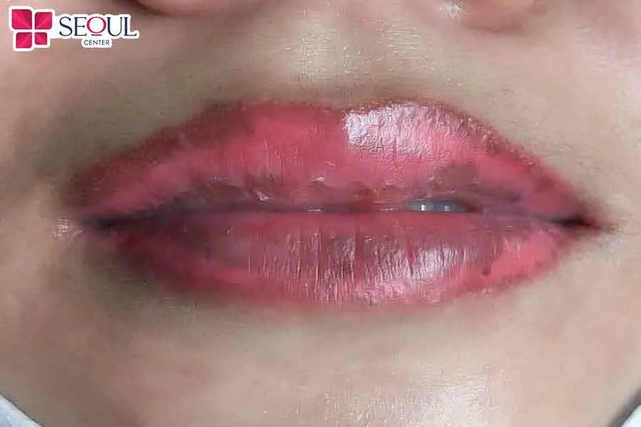 Môi bị loang lổ khiến nhiều chị em hối hận sau phun môi