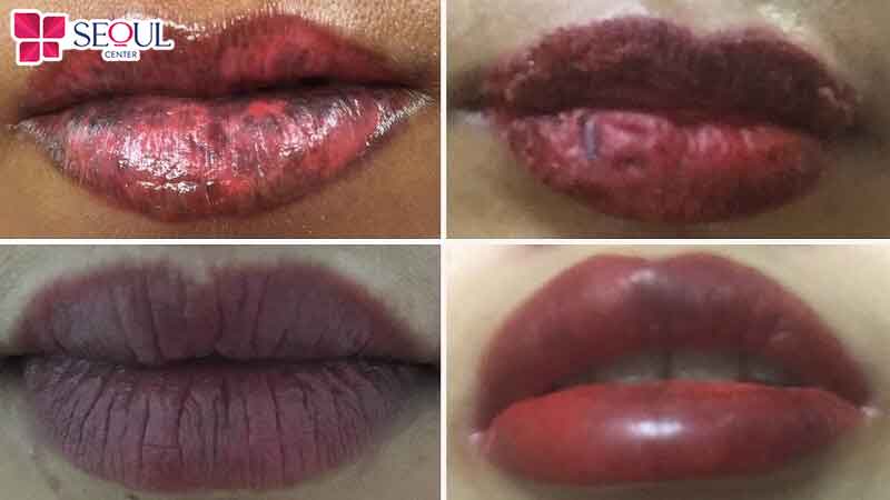 Nhiều người hối hận vì phun môi xong không thể xóa