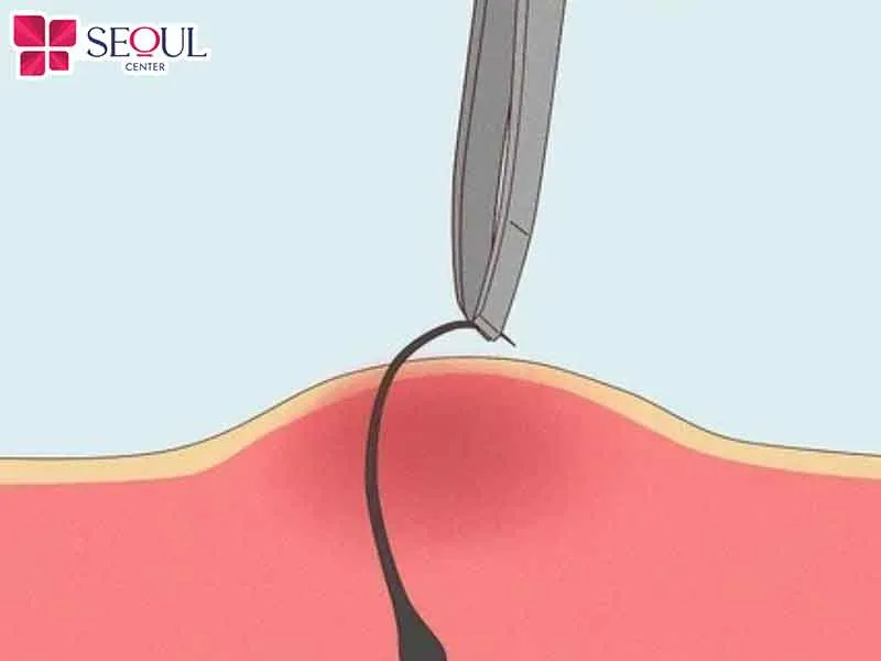 Sử dụng nhíp mới đã sát khuẩn gắp sợi lông mọc ngược ra ngoài