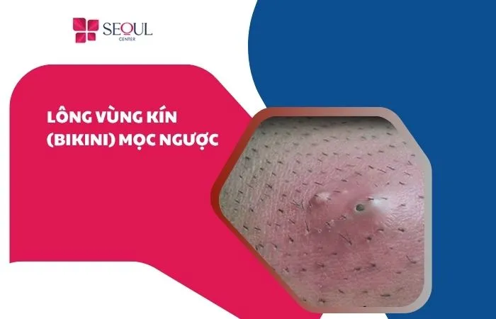Lông vùng kín bikini mọc ngược