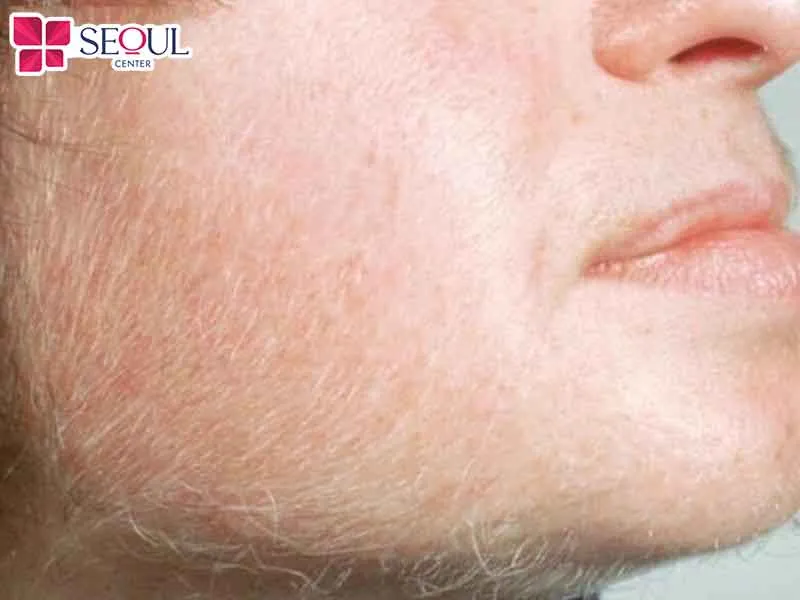 Việc cạo nhổ lông màu trắng có thể ảnh hưởng đến tài mệnh và làn da