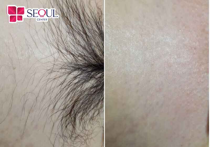 Hiệu quả triệt lông bikini thể hiện rõ rệt sau liệu trình 