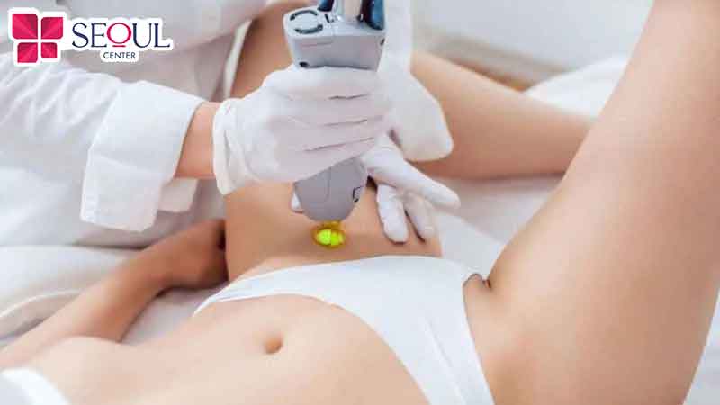 Quy trình triệt lông bikini chuẩn y khoa