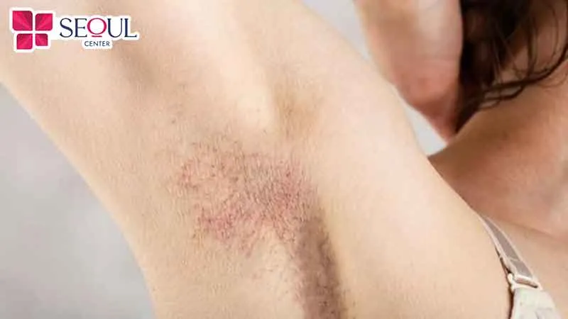 Tẩy lông nách bị rát có thể gây tổn thương da