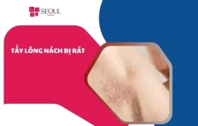 Tẩy lông nách bị rát
