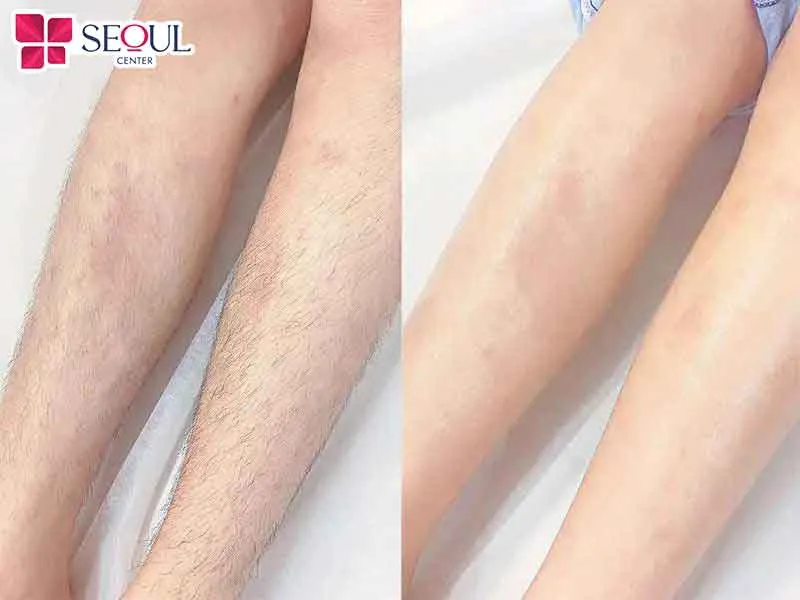 Triệt lông công nghệ Diode Laser không chỉ giúp triệt lông mà còn làm mịn da