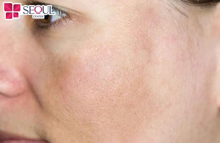 Giá triệt lông bằng công nghệ diode laser khá phù hợp với túi tiền của mọi người