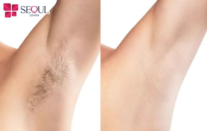 Những người muốn loại bỏ lông rậm rạp có thể tham khảo phương pháp triệt lông công nghệ Diode Laser