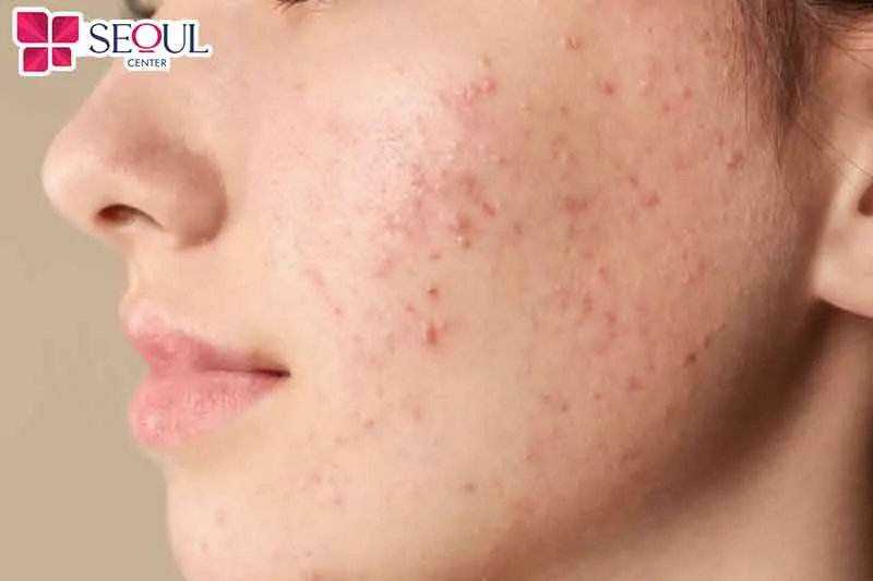 Làn da nhạy cảm thường dễ ửng đỏ với những yếu tố ảnh hưởng từ môi trường bên ngoài