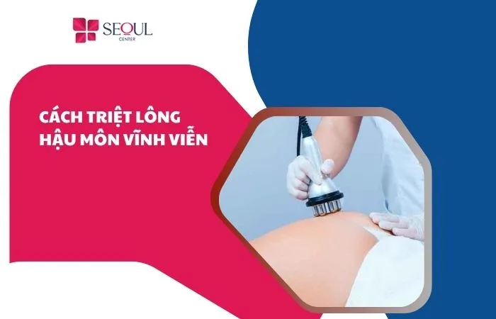 Triệt lông hậu môn vĩnh viễn
