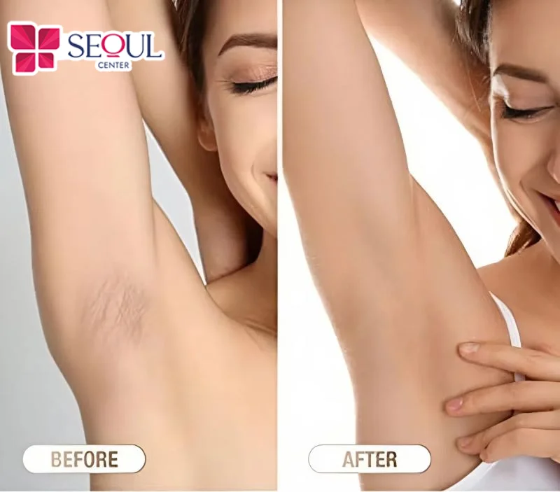 Những cách triệt lông nách vĩnh viễn đơn giản tại nhà mang lại cho bạn làn da trắng sáng, mềm mịn