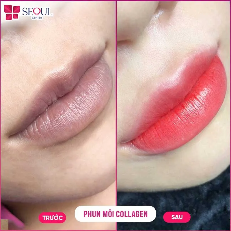 Phun môi Collagen một trong những dịch vụ phun xăm nổi bật tại Seoul Center