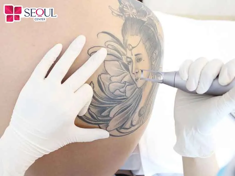 Nên xóa xăm đúng thời điểm để tránh ảnh hưởng đến thẩm mỹ của da