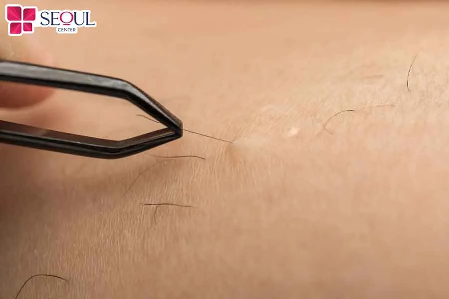 Trong trường hợp lông vùng kín khiến bạn khó chịu, mất tự tin khi diện bikini thì có thể chọn nhổ lông để loại bỏ lông vùng kín