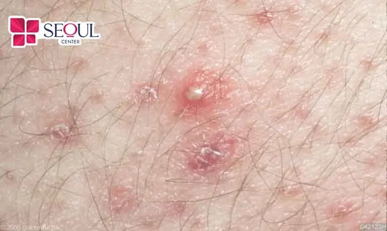 Khi nhổ lông bạn không nên dùng nhíp kẹp quá sát chân lông, hãy giữ khoảng cách khoảng 3mm để nhổ đạt  hiệu quả tốt