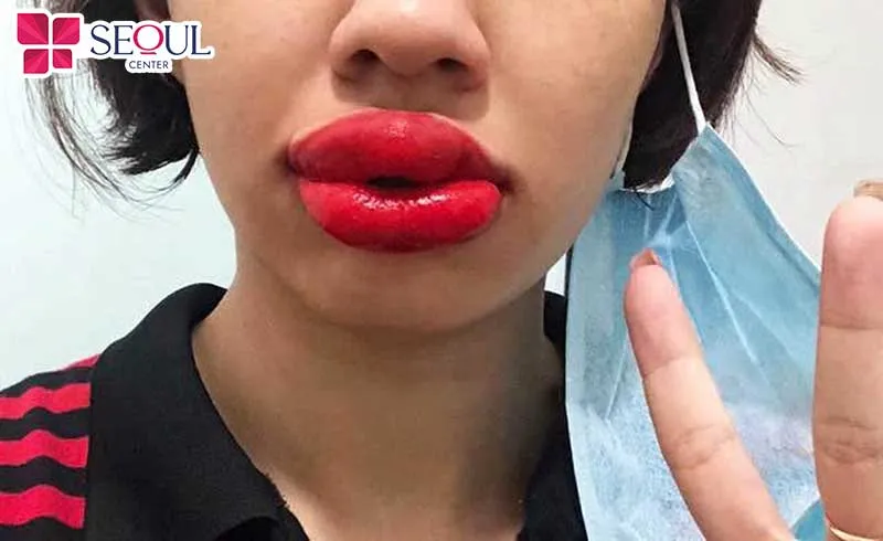 Môi có thể bị sưng đỏ vài ngày sau phun xăm môi collagen nhưng nếu kéo dài tình trạng này hãy đến  ngay cơ sở uy tín