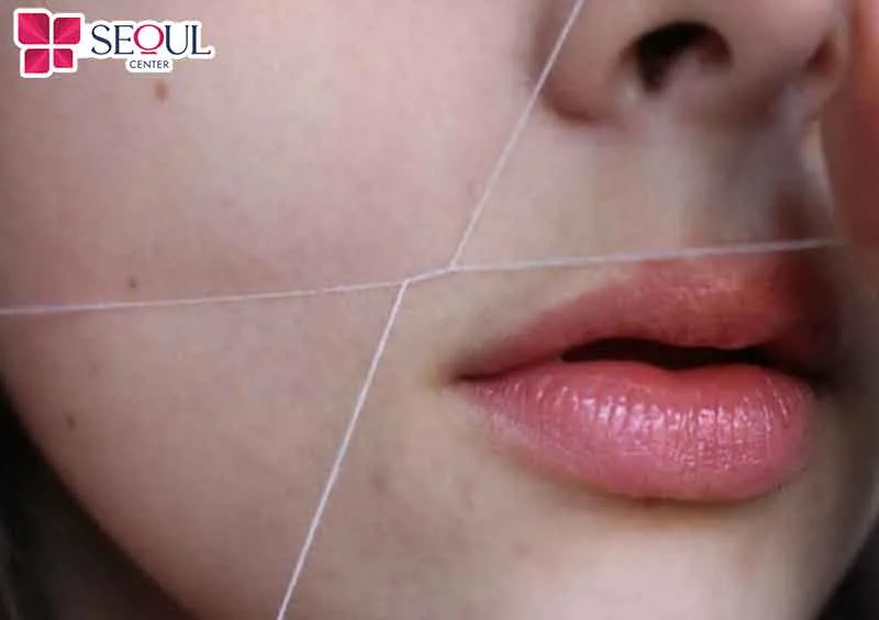 Triệt lông bằng chỉ là phương pháp dân gian được nhiều người sử dụng vì ưu điểm nhanh chóng, tiết kiệm