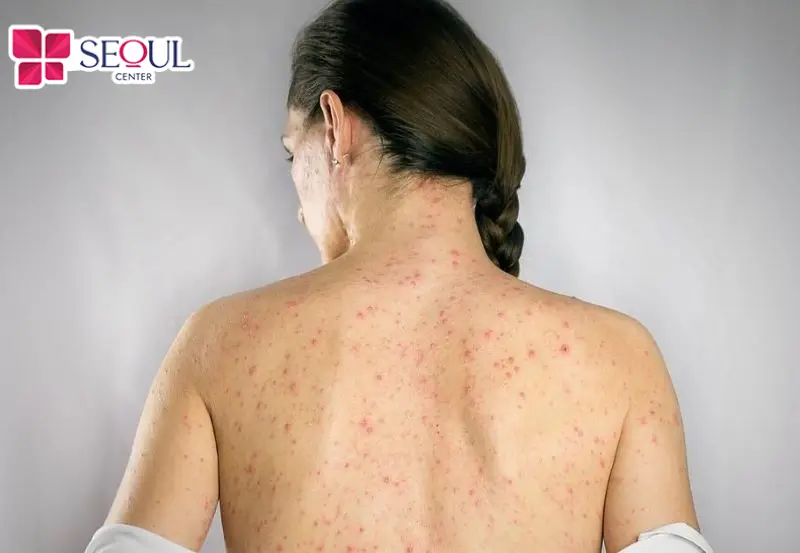 Da mẩn đỏ trong thời gian quá dài, bạn nên nhanh chóng liên hệ bác sĩ để được kịp thời hỗ trợ 