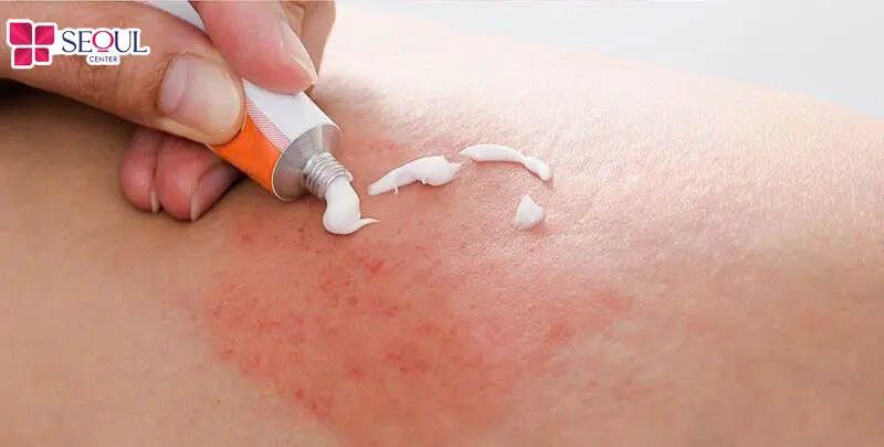 Thoa kem điều trị mẩn đỏ có thể cải thiện tình trạng này