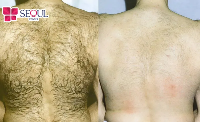Lông mọc nhiều ở lưng có thể xuất phát từ nhiều yếu tố như cơ địa, thay đổi sinh lý 