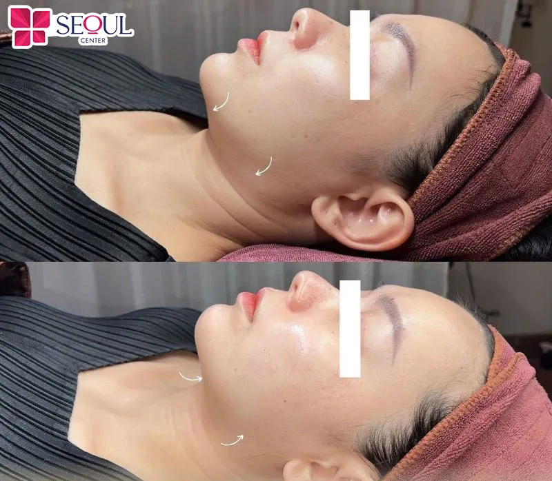 Mặc dù chi phí có thể cao hơn so với phương pháp khác nhưng hiệu quả sẽ bền lâu từ 5-10 năm 