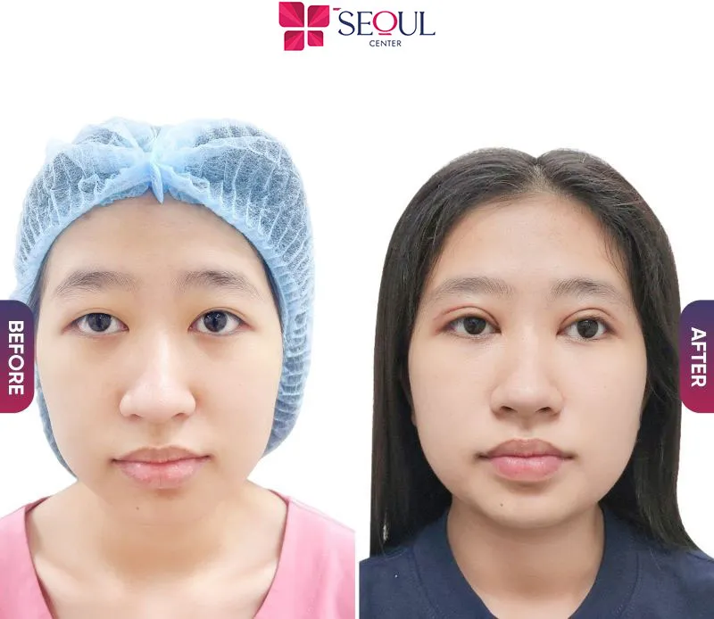 Phương pháp này sẽ giúp điều chỉnh hình dáng đôi mắt, mở rộng góc mắt nhẹ để tạo hiệu ứng mắt to, cân đối 