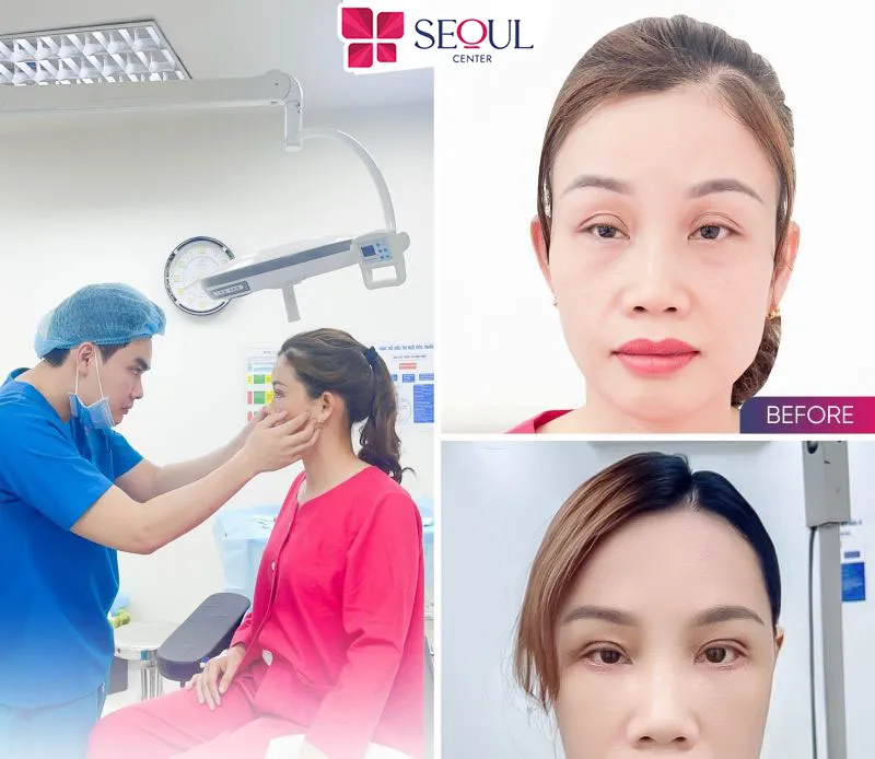 Đối với người có cơ địa da khỏe, nhanh lành thì hiệu quả có thể kéo dài trong nhiều năm, thậm chí gần như vĩnh viễn