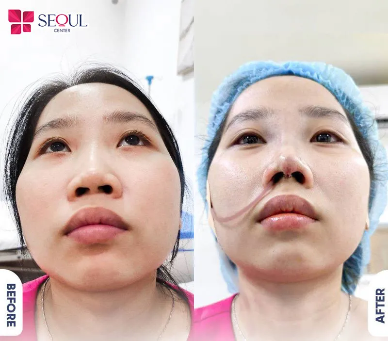 Lựa chọn lý tưởng cho những ai muốn cải thiện dáng mũi nhưng vẫn ưu tiên sự an toàn