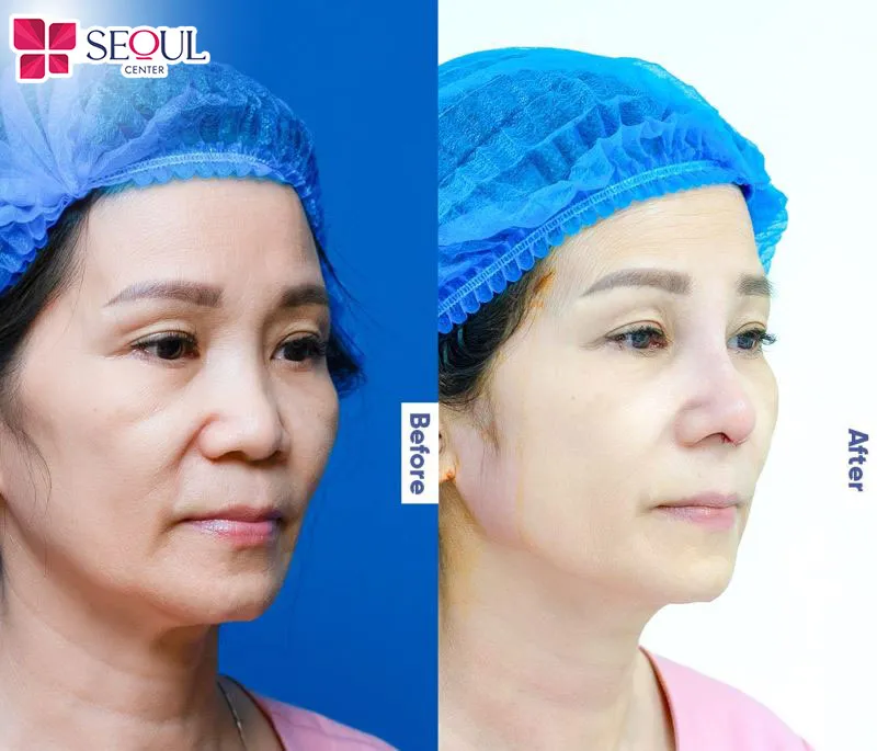 Hình ảnh dáng mũi của khách hàng trước và sau khi thực hiện nâng mũi bằng công nghệ nội soi tại Seoul Center