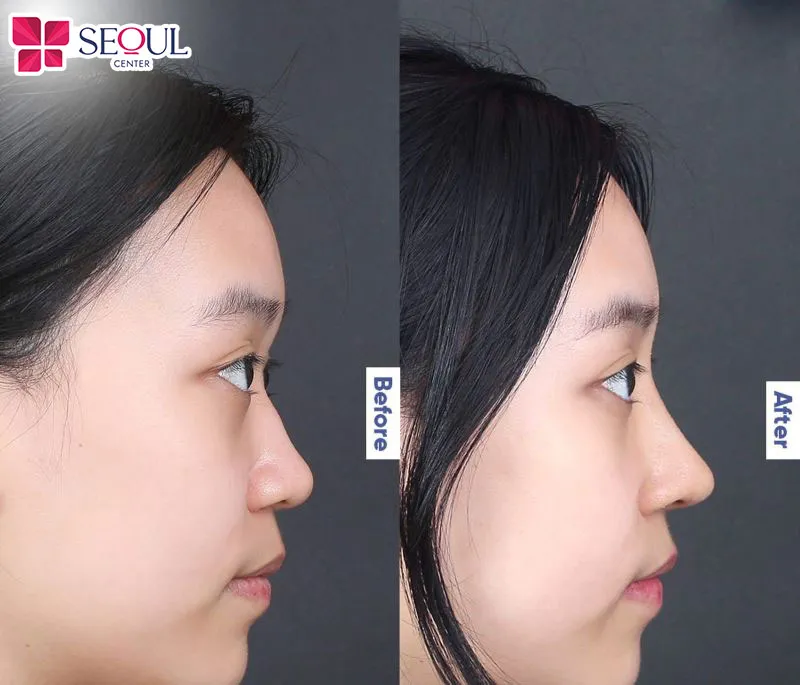 Sau phẫu thuật, mũi hồi phục nhanh, ít sưng nề và cho kết quả duy trì trong nhiều năm liền