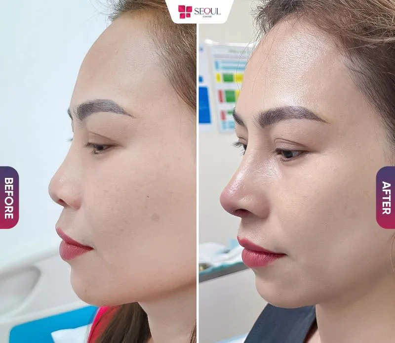 Nâng mũi bằng công nghệ nội soi không chỉ mang lại dáng mũi thanh tú, cân đối mà còn giúp bạn tự tin hơn với vẻ ngoài của mình