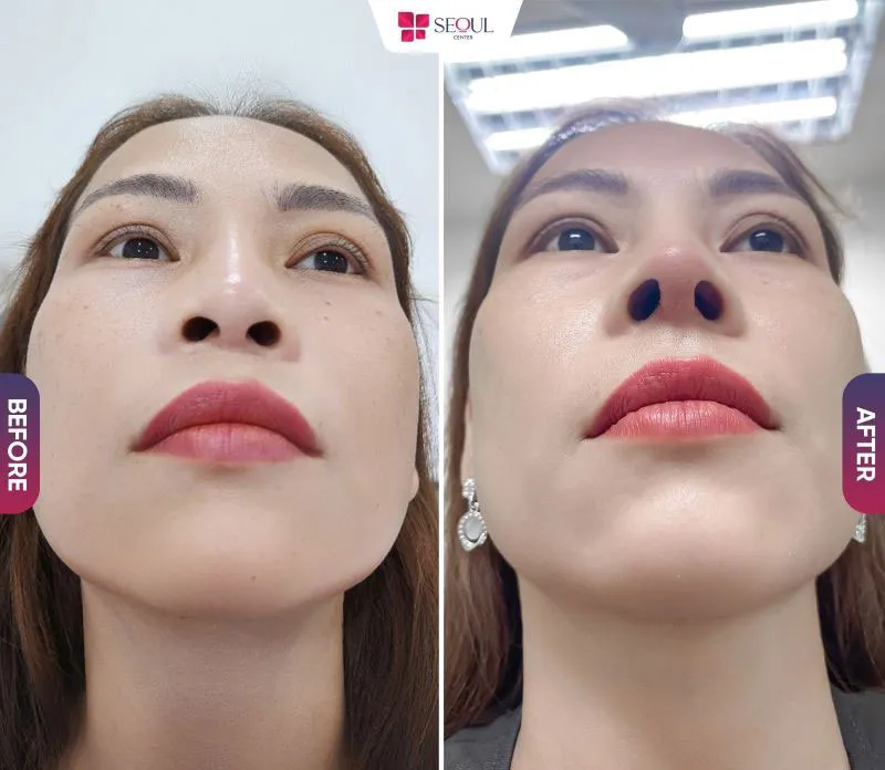 Mức giá còn phụ thuộc nhiều vào tay nghề thực hiện của bác sĩ, chất liệu sụn sử dụng cho ra kết quả dáng mũi đẹp tự nhiên