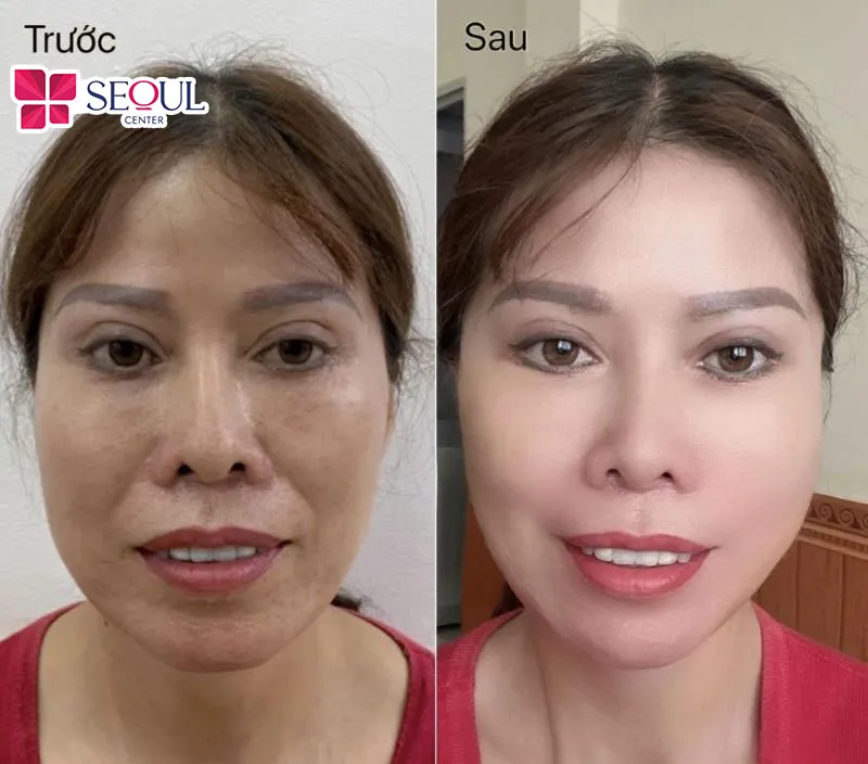 Căng da mặt sẽ giúp loại bỏ những phần da chùng nhão, cùng nếp nhăn trên gương mặt