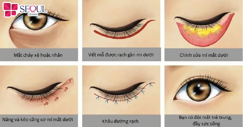 Căng da mí dưới là phương pháp khắc phục nhiều tình trạng lão hóa mắt bằng kỹ thuật bóc tách, loại bỏ mỡ thừa và kéo căng cơ mí dưới