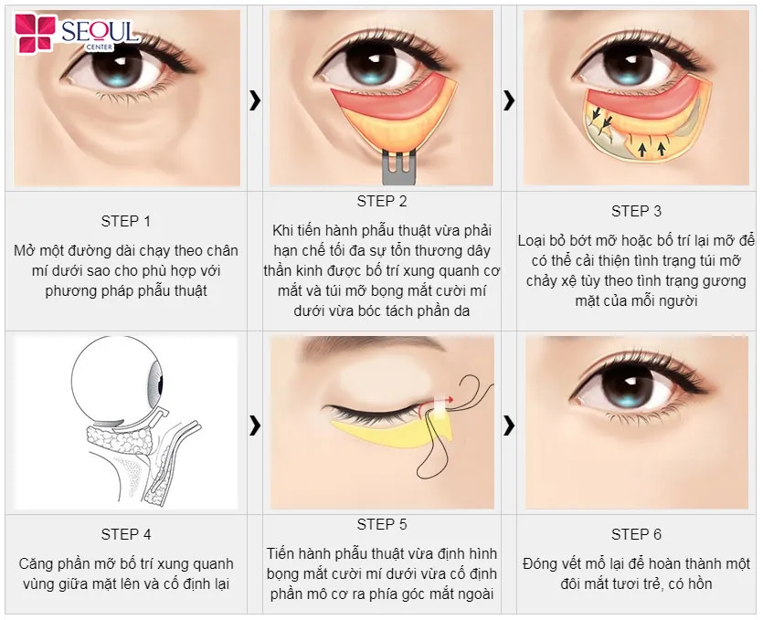 Cơ chế khắc phục các vấn đề lão hóa phần da mí dưới