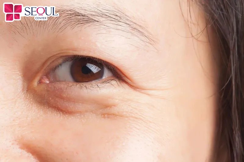 Những ai có vùng mí dưới chảy xệ, nếp nhăn, vết chân chim muốn khắc phục triệt để có thể tham khảo phương pháp căng da mí dưới