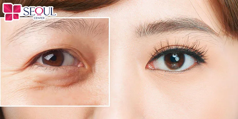 Cắt mí mắt mini chỉ rạch một đường ngắn để tạo đôi mắt hai mí rõ nét